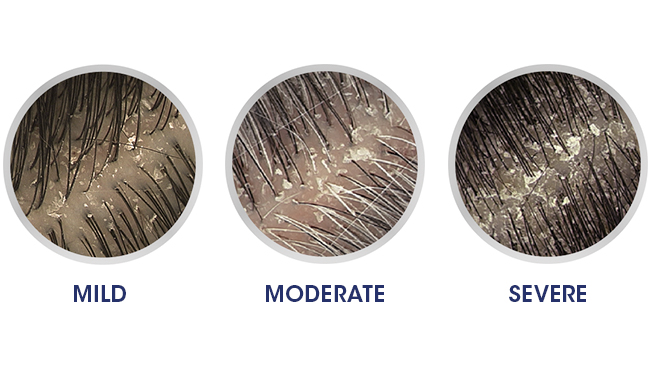 علت شوره سر و بهترین روشهای درمان قطعی (دارویی و خانگی) 3 انواع شوره سر